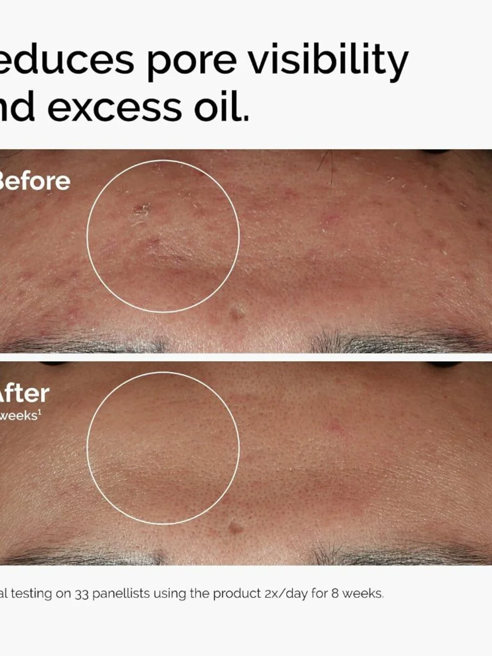 The Ordinary Niacinamide 10% + Zinc 1%, Smoothing Serum for Blemish-Prone Skin
